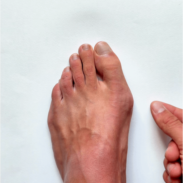 Hallux-valgus-Bandage