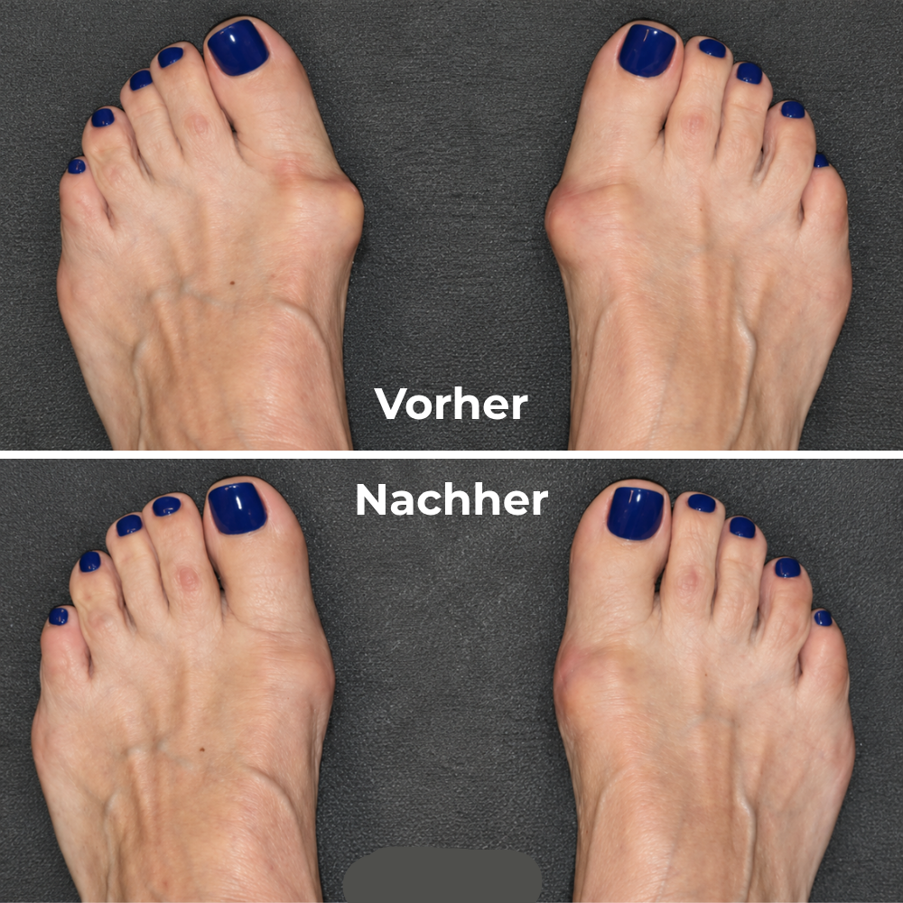 Hallux-valgus-Bandage