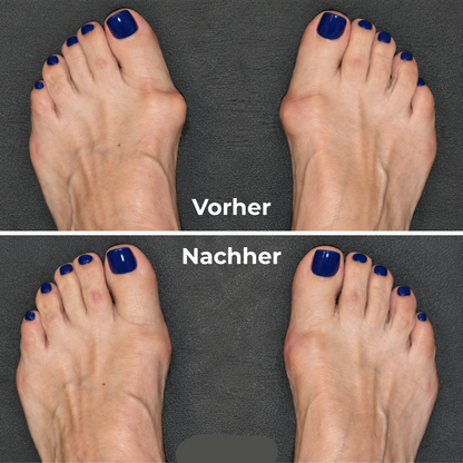 Hallux-valgus-Bandage
